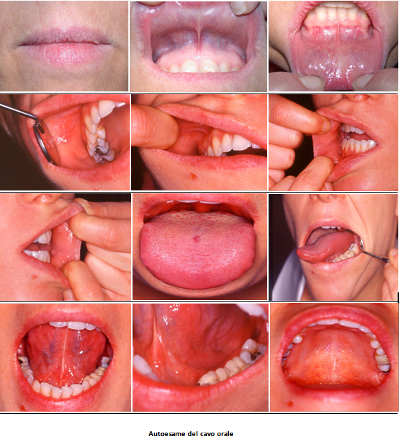 Papilloma interno bocca