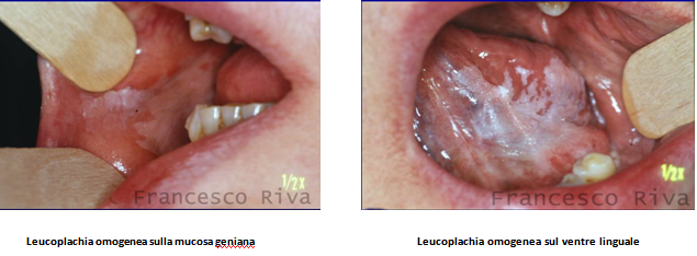 INTREABA-MA! Afte in bocca papilloma virus