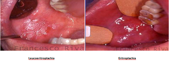 Afte in bocca papilloma virus, Rotunjire cum să obțineți după tratament