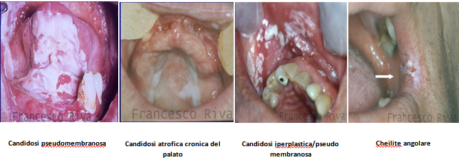 colonizzazione papilloma virus