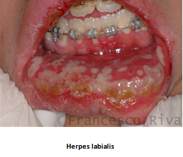 papilloma virus sul labbro